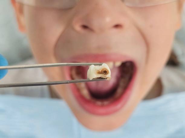 Best Urgent Care for Lost Fillings or Crowns in Cleveland, AL